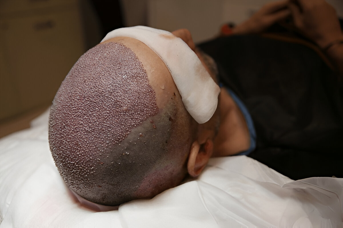 hair transplant UK