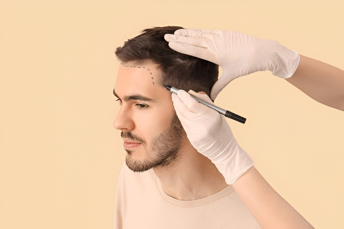 hair transplant UK