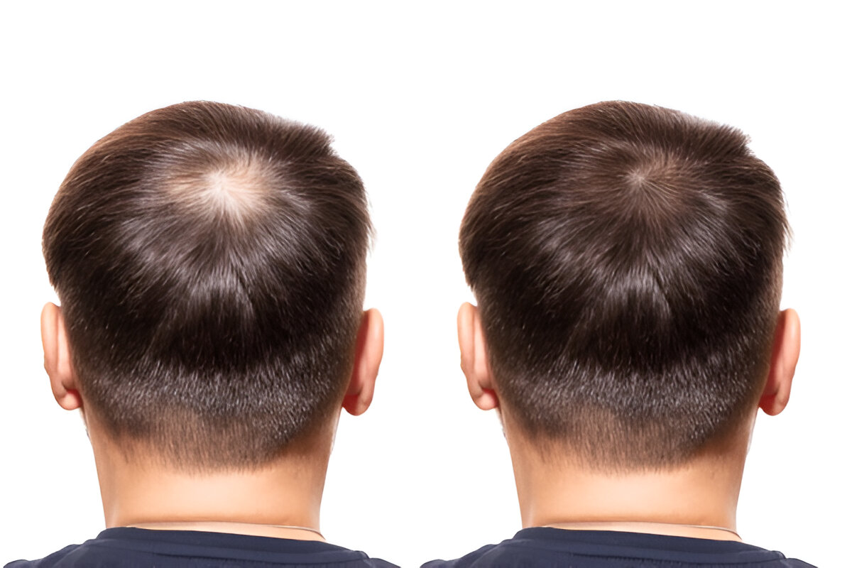 best hair transplant London