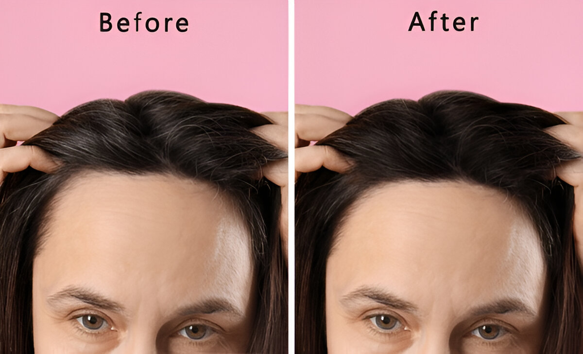hair transplant