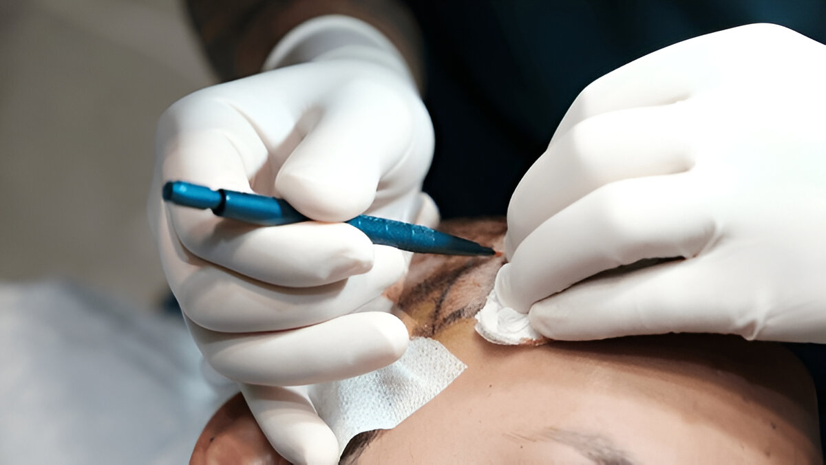 Hair Transplant