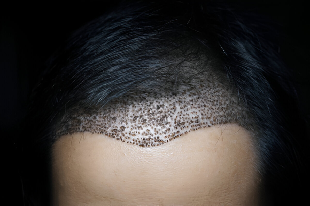 Hair Transplant