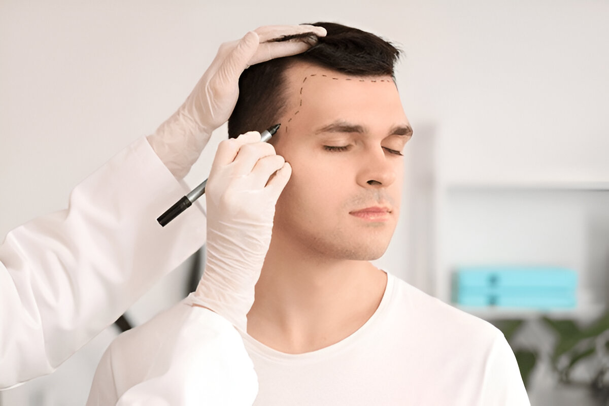 hair transplant Manchester