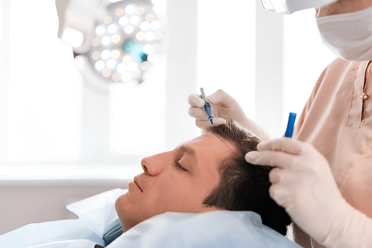 hair transplant Bristol
