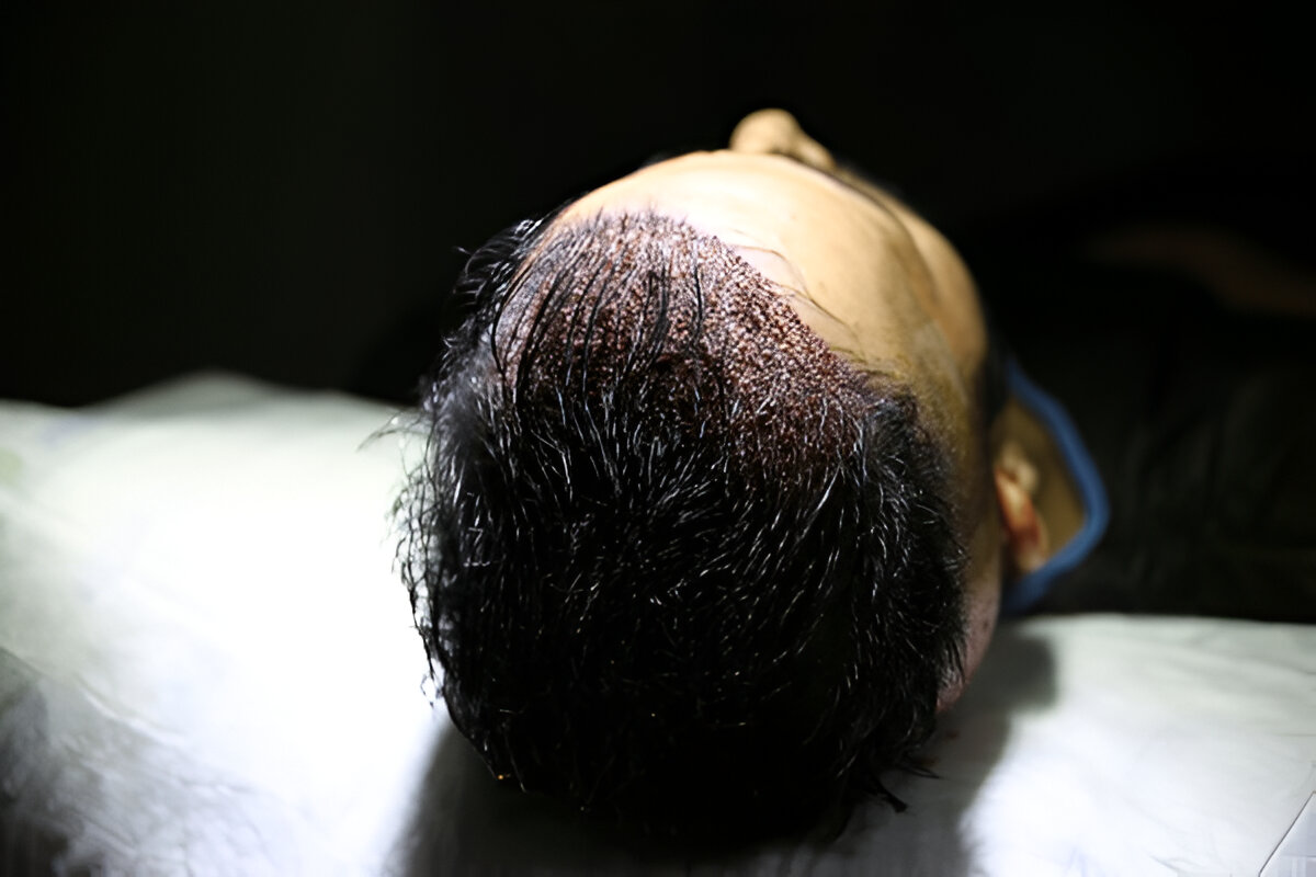 hair transplant Cardiff