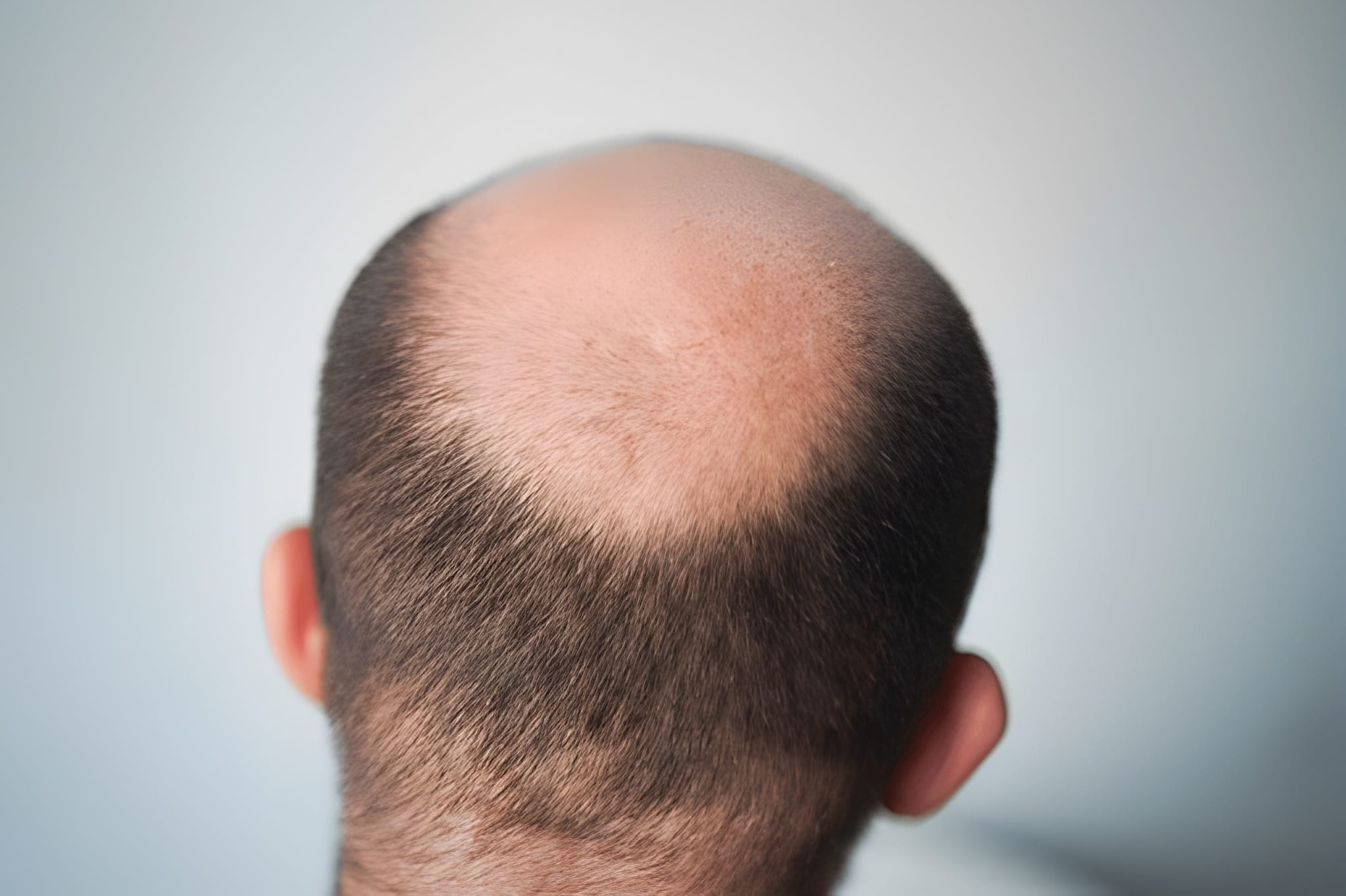 Hair Transplant