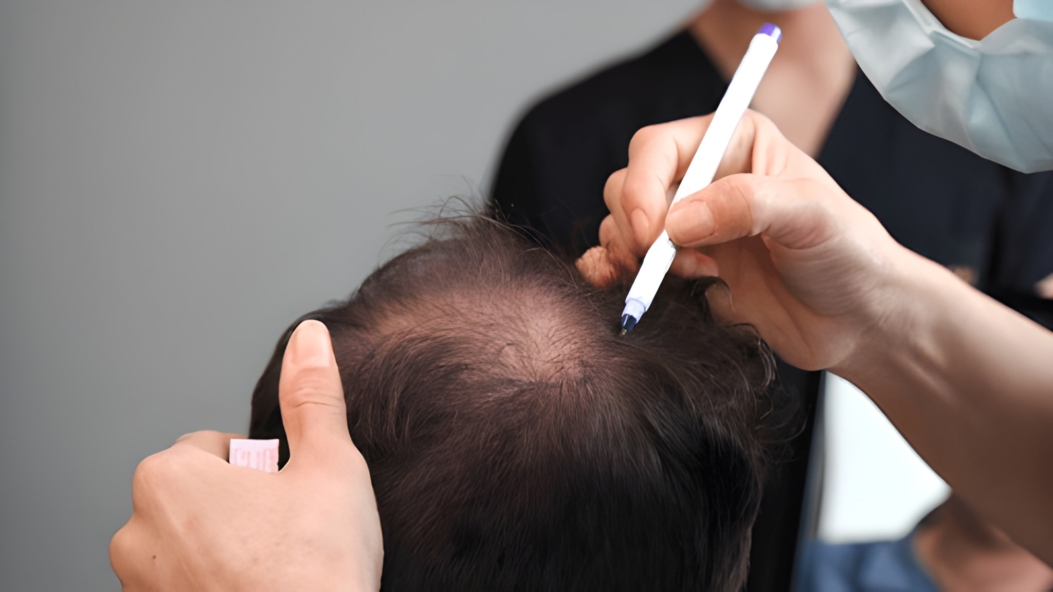 Hair Transplant